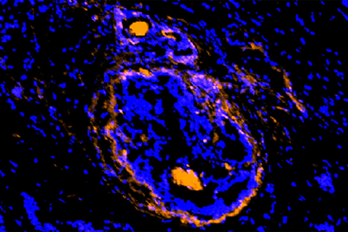 A new imaging agent, developed at Washington University School of Medicine in St. Louis, illuminates cancerous cells of a breast tumor. The new agent lights up cancer cells and the supporting cells that act as a shield, protecting the tumor from various treatment strategies. The new investigational agent is being tested in small clinical trials.