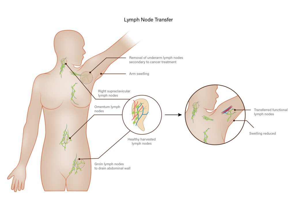 Lymph Node Transfer
